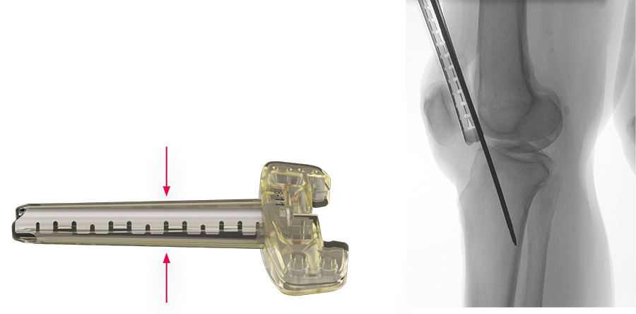 Titanium Elastic Nail (TEN),Medical Device Manufacturers -Double Medical